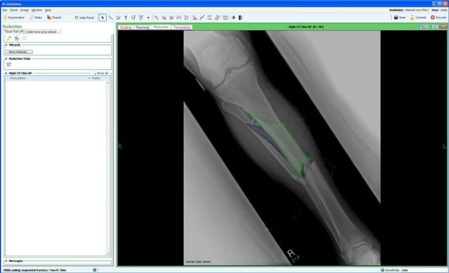 Planning software module / medical / orthopedic surgery Fracture Management OrthoView