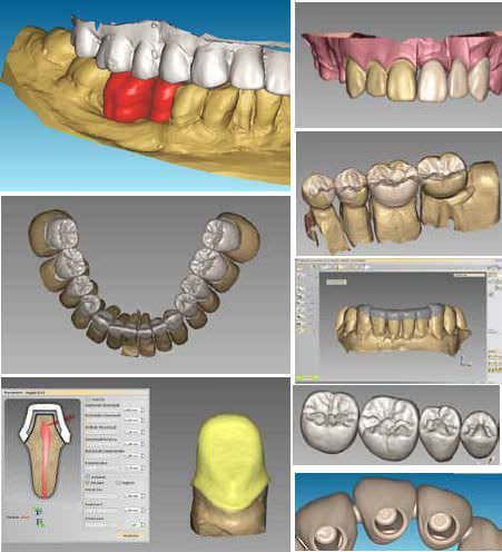 CAD software / CAM / for dental prosthesis design / medical OpenCAD V.4 Laserdentium