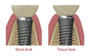 Tapered dental implant / internal octagon NR Line Dentium USA