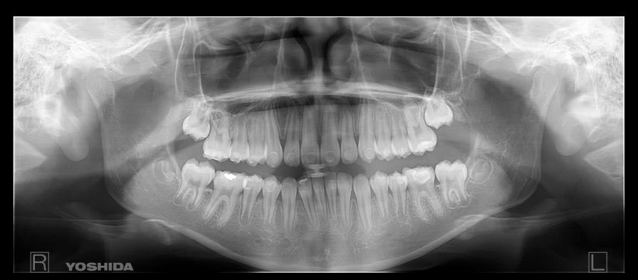 Cephalometric X-ray system (dental radiology) / panoramic X-ray system / dental CBCT scanner / digital Panoura 18S Image Works