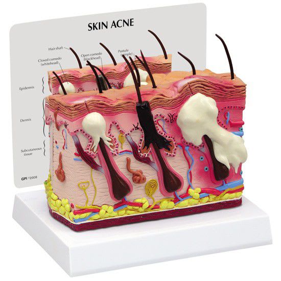 Skin pathology anatomical model 3751 GPI Anatomicals