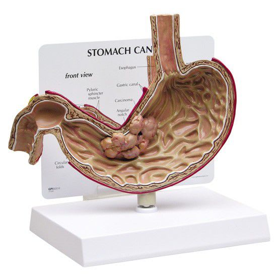 Stomach pathology anatomical model 2001 GPI Anatomicals