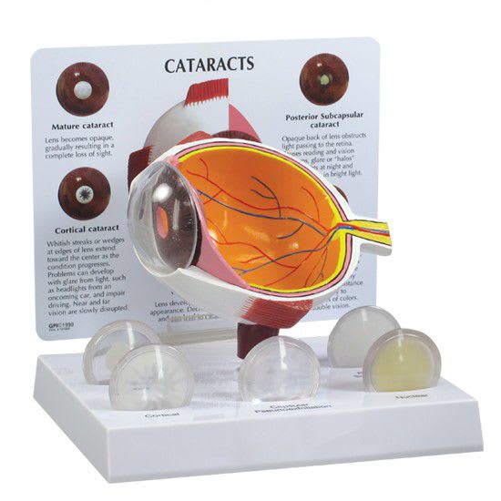 Eye pathology anatomical model 2800 GPI Anatomicals