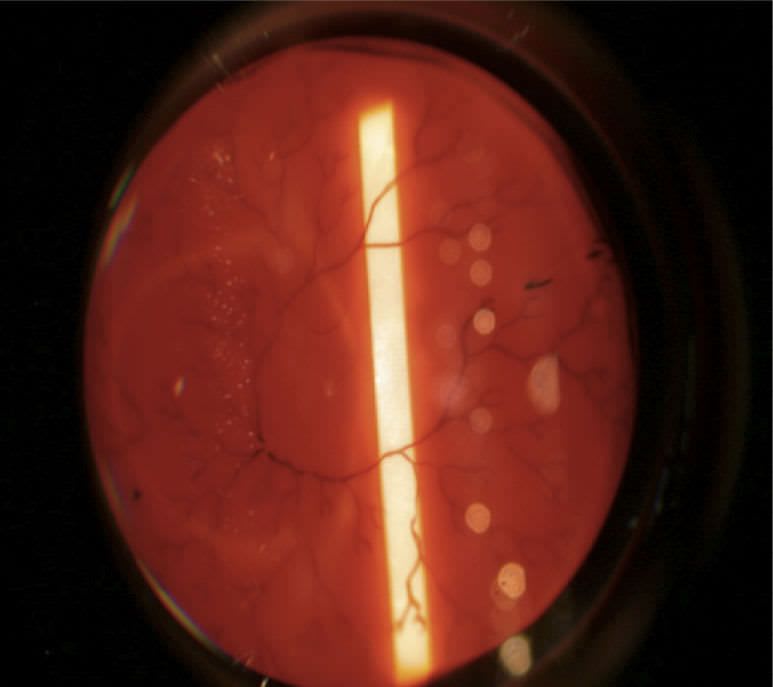 Ophthalmic laser / for retinal photocoagulation / diode / tabletop Integre Pro™ Ellex Medical