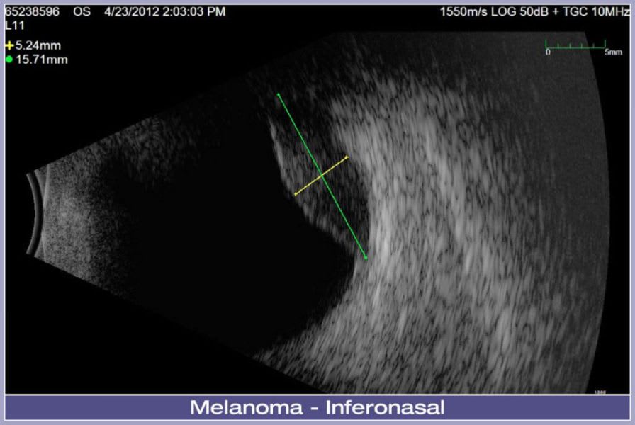 Ultrasound system / on platform, fixed / for ophthalmic ultrasound imaging Eye Cubed™ Ellex Medical