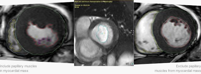 Diagnostic software / 3D viewing / analysis / cardiology CMR42 Circle Cardiovascular Imaging
