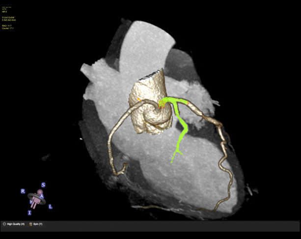 Viewing software / diagnostic / medical / cardiovascular CT42 Circle Cardiovascular Imaging