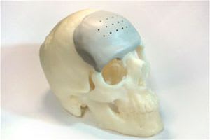 Cranial implant PK-Shield™ Osteo Symbionics