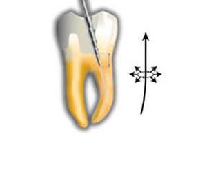 Nickel titanium endodontic file ENDOFLARE® Micro-Mega