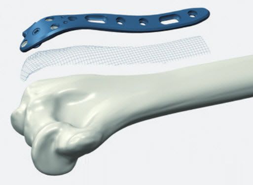 Humerus compression bone plate / distal ALIANS ELBOW Newclip Technics