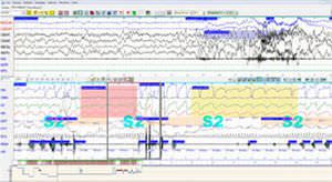 Polysomnograph with EEG Deltamed Coherence® Natus Medical Incorporated