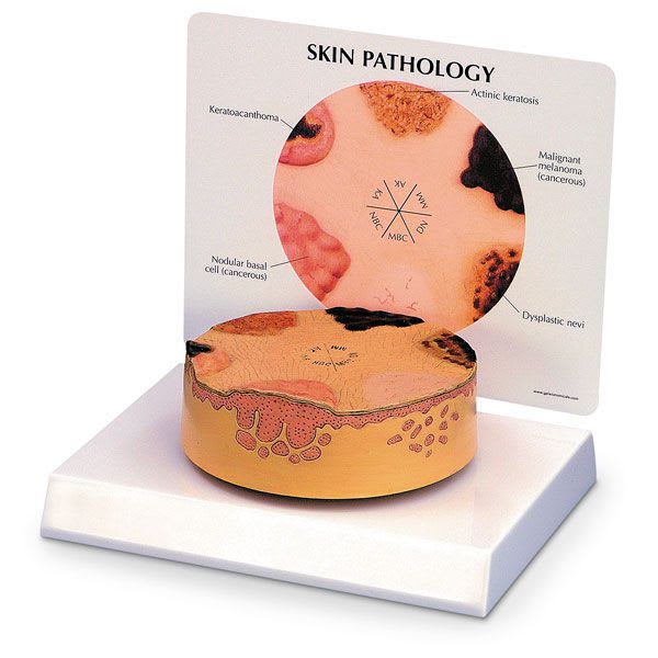 Skin pathology anatomical model SB28295G Nasco