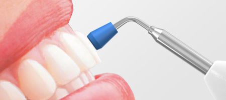 Pulp vitality tester RootBuddy Nikinc Dental
