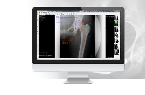 Preoperative planning software / medical / orthopedic surgery Merge OrthoCase™ MERGE Healthcare
