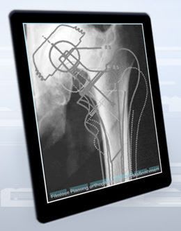 Planning software / surgical / medical / orthopedic VIMED® ORTHO MEYTEC
