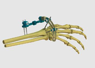 Human external fixation system / wrist Stylo kit MIKAI
