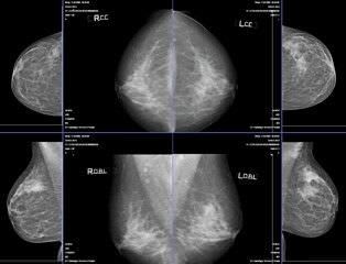 Diagnostic software / viewing / for mammography / medical MAMMOVIEW Medigration