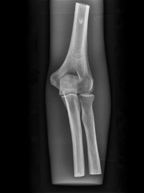 Radiography test phantom / elbow 7260 Erler-Zimmer Anatomiemodelle