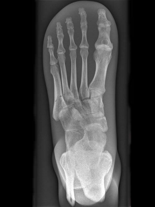 Radiography test phantom / foot 7230 Erler-Zimmer Anatomiemodelle