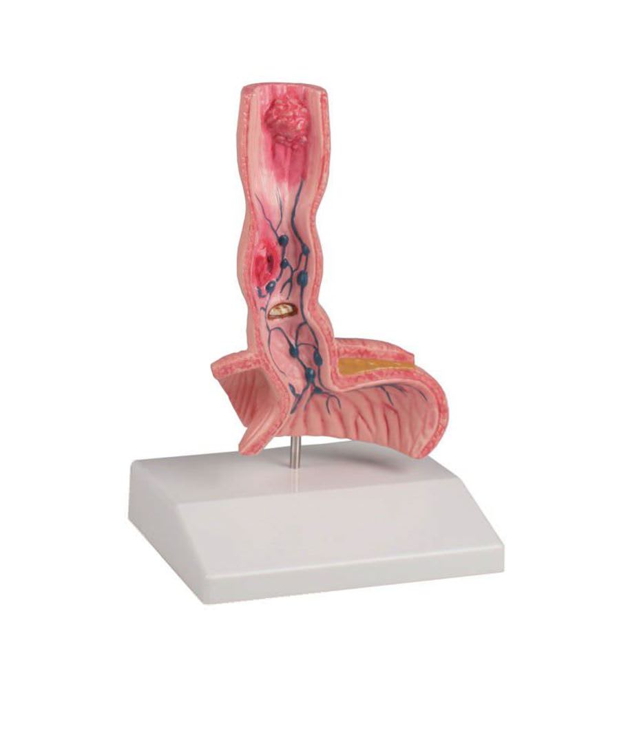 Oesophagus pathology anatomical model K218 Erler-Zimmer Anatomiemodelle