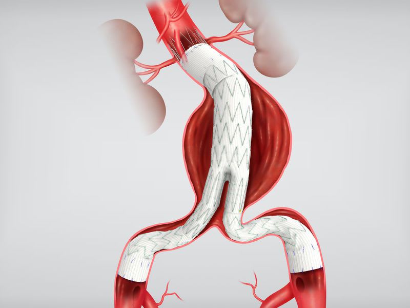 Endovascular stent graft / abdominal / stainless steel 18 - 22 F | Zenith Flex® AAA series COOK Medical