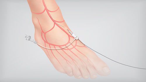 Microintroducer catheter 2.2.9 F | Micropuncture® Pedal Access COOK Medical