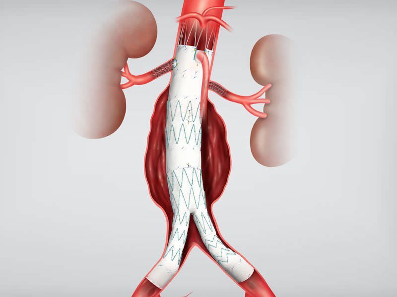 Endovascular stent graft / stainless steel 20 F | Zenith® Fenestrated AAA series COOK Medical