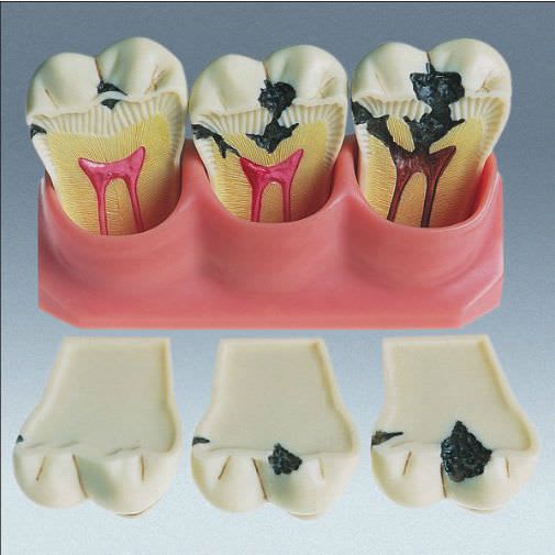 Tooth pathology anatomical model D-4 frasaco