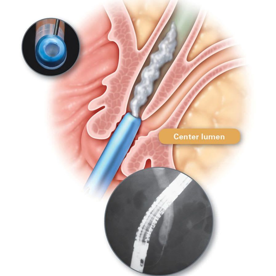 Sphincterotome Dreamtome™ RX Boston Scientific