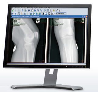 Preoperative planning software / medical / orthopedic surgery ORTHOVIEW Carestream