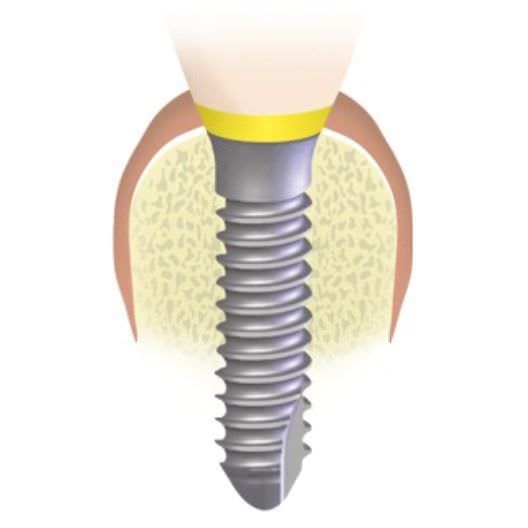 Dental mini-implant EASY SYSTEM IMPLANT