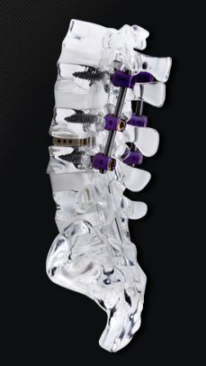 Lumbo-sacral spinal osteosynthesis unit / posterior SYNSTER® BM Korea
