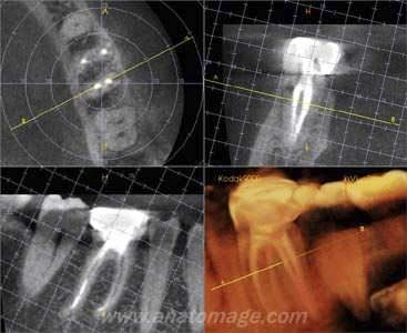 Viewing software / medical / for dental imaging Endodontics Anatomage