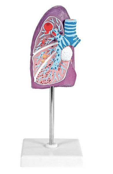 Lung pathology anatomical model 6120.12 Altay Scientific