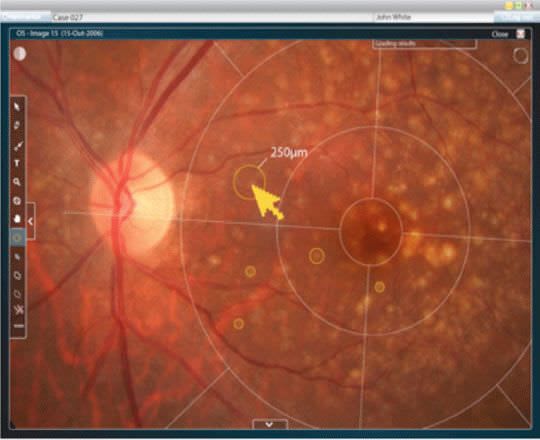 Viewing software / diagnostic / medical / ophthalmology RetmarkerAMD critical-health
