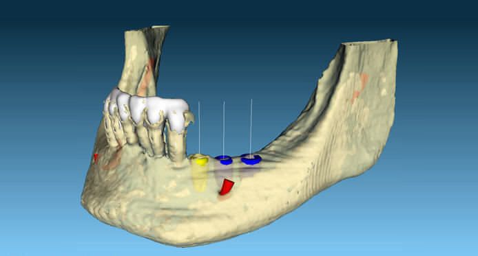 Diagnostic software / planning / 3D simulation / for implantology BTI Scan® II BTI Biotechnology Institute, S.L.