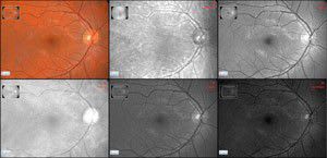 Non-mydriatic retinal camera (ophthalmic examination) COBRA bon Optic Vertriebsgesellschaft
