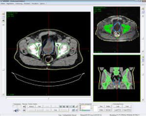 Treatment plan evaluation software / contouring / multimodal image fusion / medical imaging ARTIVIEW™ AQUILAB